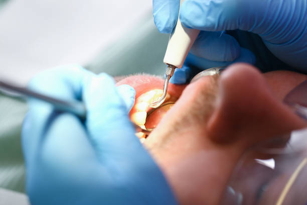 Best Dentist for Tooth Abscess  in San Luis, AZ